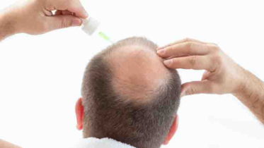 তাইওয়ানের যে সিরাম ব্যবহারে মাত্র ২০ দিনে গজাবে চুল তাইওয়ানের যে সিরাম ব্যবহারে মাত্র ২০ দিনে গজাবে চুল