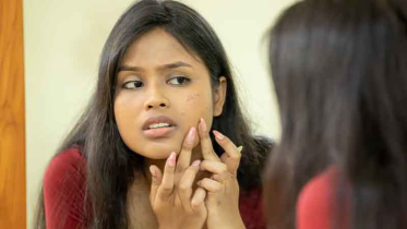 ব্রণের দাগ কমাতে প্রাকৃতিক উপাদান